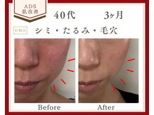 リュミエール(Lumiere)の雰囲気（40代☆ADS肌改善（たるみ・たるみ毛穴・くすみ）改善３ケ月症例）