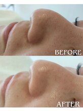 ギーク ラボ(GEEK LABO)/ワイコ水光ピール1回