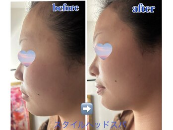 オーロラ(Aurora)/フェイスラインすっきり♪