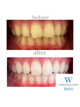 ホワイトニングショップ 池袋店/【ビフォーアフター】美白