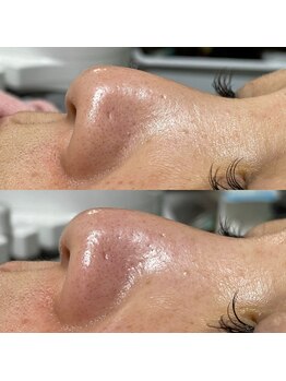 ティグレ 岡山店(TIGRE)/毛穴洗浄