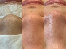 ビヨンド リンク(BEYOND L'INK)/韓国式3D毛穴洗浄