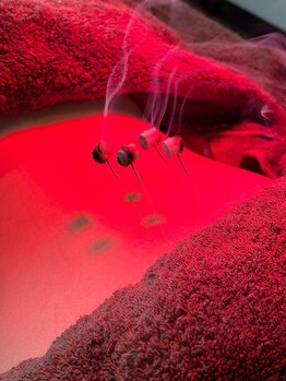 宮町鍼灸整骨院/冷え対策にも!灸頭鍼