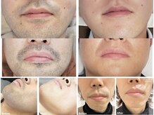 完全個室で安心して施術いただけます！肌荒れ改善にも◎