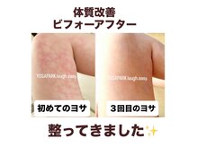 浮腫と冷えでまだらになっていた足。改善されてきました☆