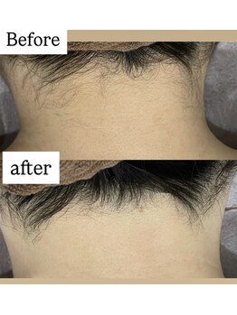 レヴール(reveur)/うなじ脱毛[美容脱毛/新潟脱毛]