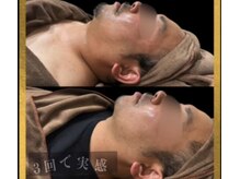 ラフィールの雰囲気（小顔 : ファイシャル：３回でフェイスラインスッキリ！）