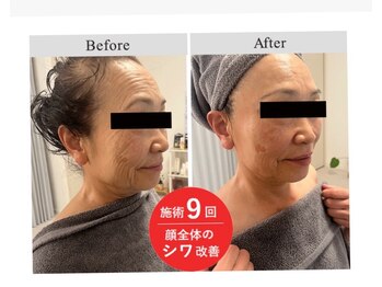 トータルビューティーサロン バンブー(Bamboo)/エクソソームで美肌へ