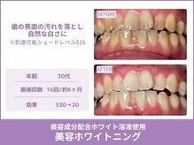 クレア(Crea)/【歯のホワイトニング症例写真】