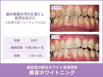 クレア(Crea)/【歯のホワイトニング症例写真】