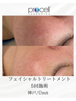 ユミト(Umit)/プロセルフェイシャル