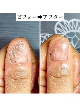 負傷した爪も早く育て入れ替える