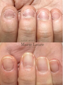 マリーロール 淀屋橋本店(Marie Laure)/自爪育成/深爪矯正/ネイルケア
