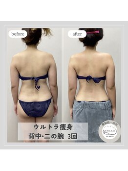 カラー(CALLA)/神の手ウルトラ痩身