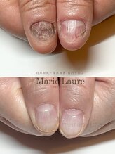 マリーロール 梅田店(Marie Laure)/自爪育成/深爪矯正/ネイルケア