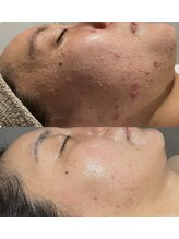 インチャント(enchant)/ゴワつき/ニキビケア