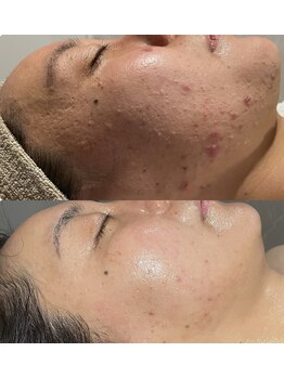 インチャント(enchant)/ゴワつき/ニキビケア