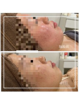 リリーガーデン 手稲店(Lily Garden)/ビフォーアフター 毛穴/ニキビ