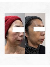 アルル 甲賀(ARuru)/シワやたるみも得意です！