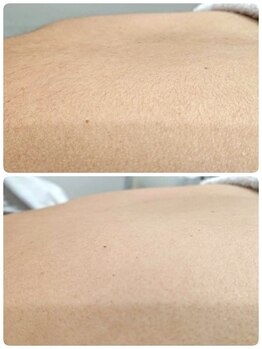 エステシェービングサロン フルール(Fleur)/背中のシェービング