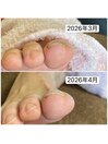 巻き爪ケア