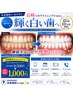 セルフホワイトニング通常 9,500円 → 1,000円