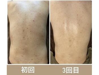 美肌研究所 絹 田辺店/ハーブピリングでお背中も綺麗に