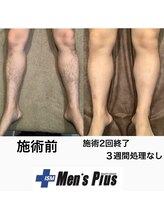 メンズプラス(Men's Plus)/【施術事例】