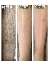 ゲッカ(GEKKA)/メンズ脚脱毛も経過☆