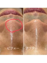 ジェンナ(Jann)/毛穴洗浄！いちご鼻解消