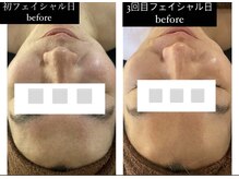 キコ リラクゼーションサロン(KICO by PLUS)/肌質改善フェイシャル