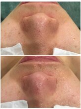 叶(Kanau)/毛穴エクストラクション1回