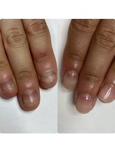 マニュコクーン(ManuCocoon)/爪育成　深爪　巻き爪　大阪市