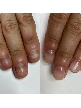 マニュコクーン(ManuCocoon)/爪育成 深爪 巻き爪 大阪市