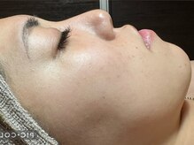 フィール(feel)/After　期間：4カ月