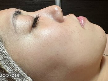 フィール(feel)/After 期間:4カ月