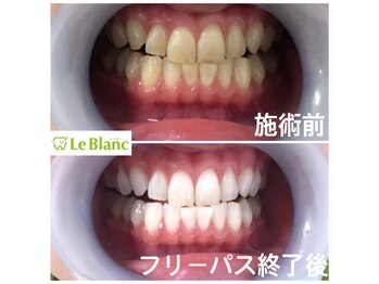 ルブラン 奈良店(Le Blanc)/口腔内すっきり!!