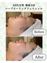 シーフェイス 横浜店(SEE FACE)/ハーブピーリングハリツヤアップ