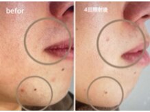 ノア(NOA.)/好感度＆清潔感UP【ヒゲ脱毛】