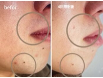 ノア(NOA.)/好感度＆清潔感UP【ヒゲ脱毛】