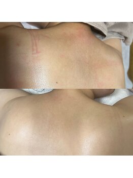 ミオワックス(MIOWAX)の写真/【南福島駅前/駐車場有◎】美背中を目指して！ざらついた背中のニキビ予防に。