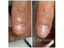 ミコ(.mico)の雰囲気(自爪育成、深爪、巻き爪、変形爪の補正や再生を行っております。)