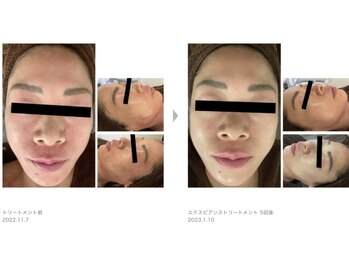 ビューティーサロンレモン(Lemon)/芸能人ピーリング