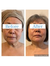 ナル(NALU)/フェイシャル