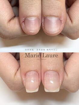 マリーロール 梅田店(Marie Laure)/深爪矯正/自爪育成/自爪風