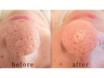 サロン ザ プマロ(SalonThePumalo)/毛穴エクストラクション