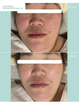 サンラックスサロン 岐阜(SANlux Salon)/アンストレスビフォーアフター