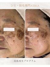 アトリア(ATRIA)/肌質改善プログラム