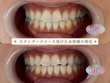 モンキーホワイトニング 西千葉/お得な初回スタンダードコース♪