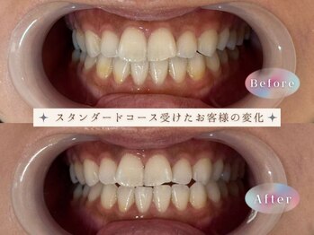 モンキーホワイトニング 西千葉/お得な初回スタンダードコース♪
